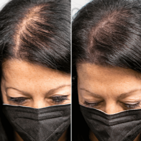 Micro Scalp Densificación Capilar 1 Zona