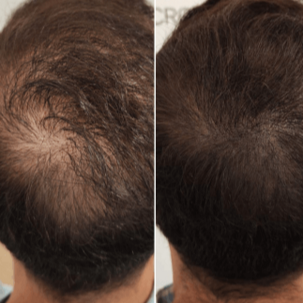 Micro Scalp Densificación Capilar 1 Zona