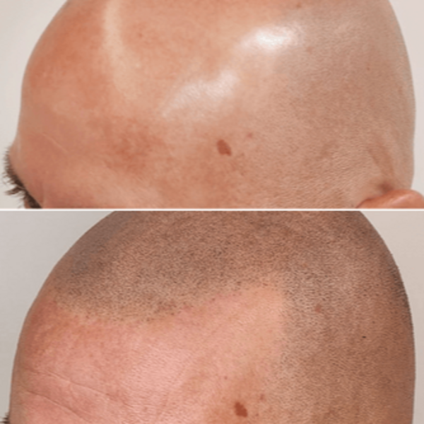 Micro Scalp - Efecto Rapado 