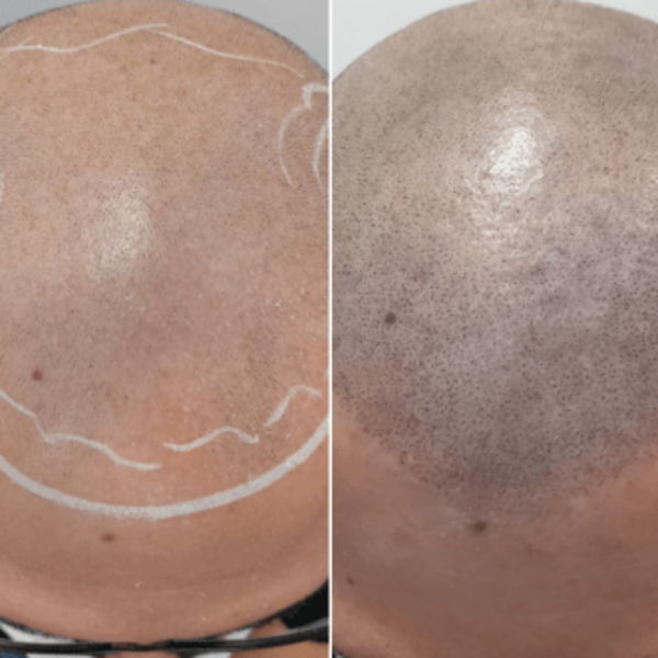 Micro Scalp - Efecto Rapado 