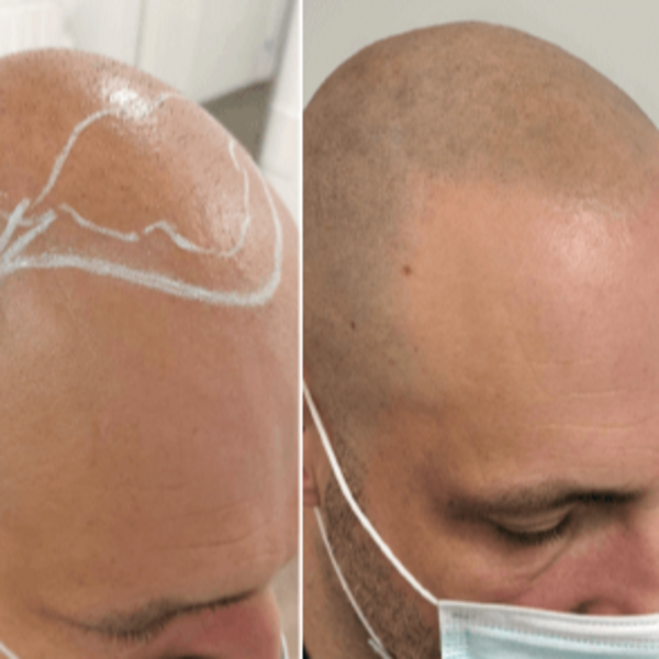 Micro Scalp - Efecto Rapado 