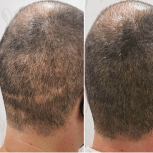 Micro Scalp - CICATRICES