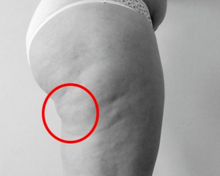 Trat. Celulitis en zona bajo glúteo 