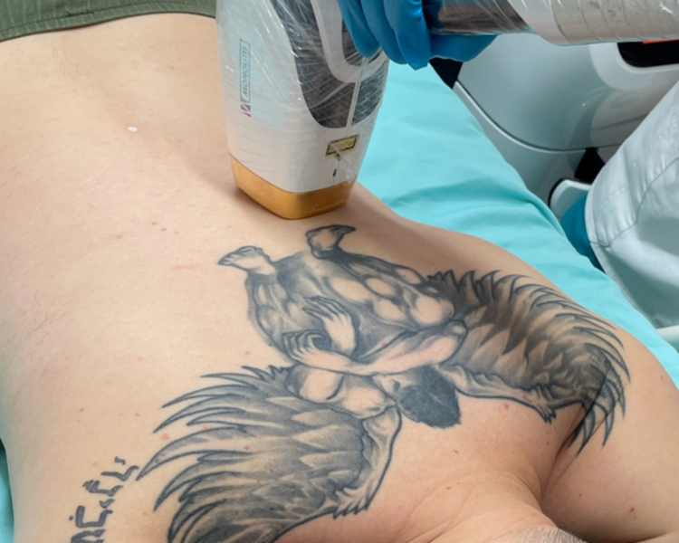  ESPALDA COMPLETA (1 sesión) Depilación Láser Diodo