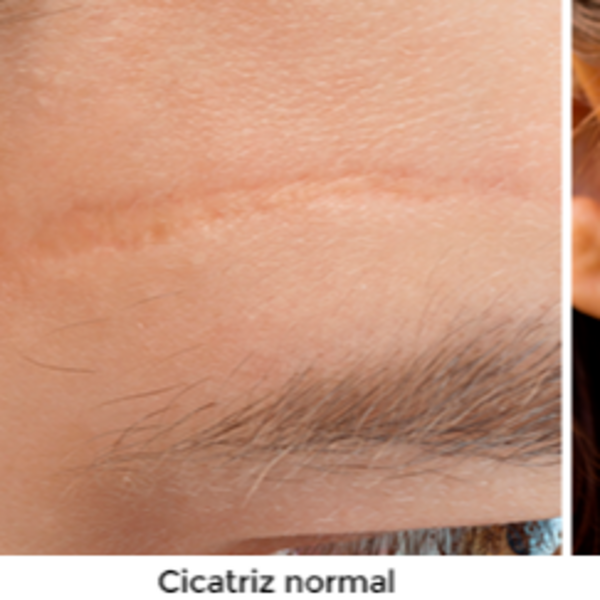 Tratamiento sobre cicatrices 