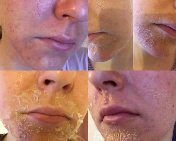 Peeling Organico de Algas