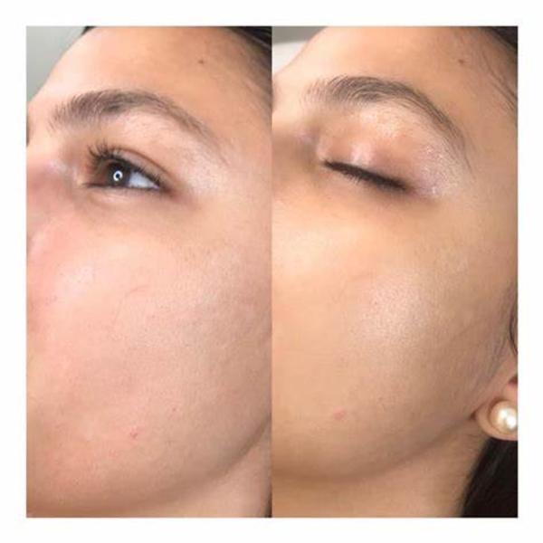 Microneedling + BB GLOW