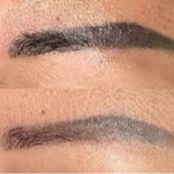 REMOCIÓN DE TATUAJES DE CEJAS 5 SESIONES 