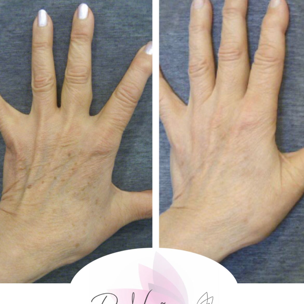 Sesión Láser para la eliminación de manchas en manos, cuello o escote