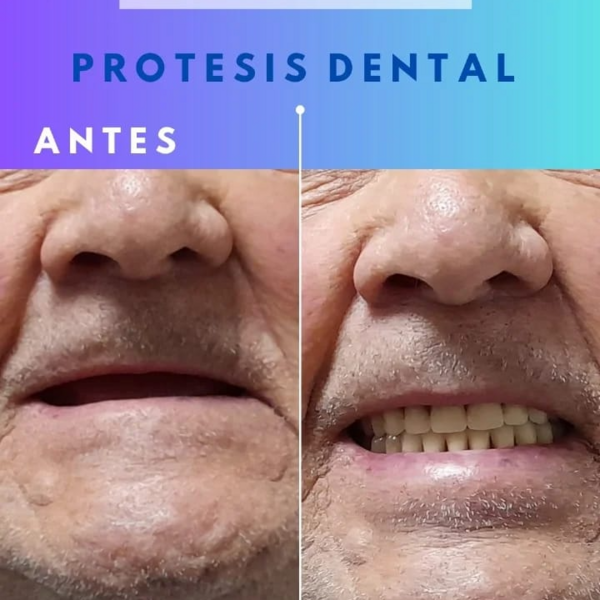 Protesis Acrilicas / Metalicas 
