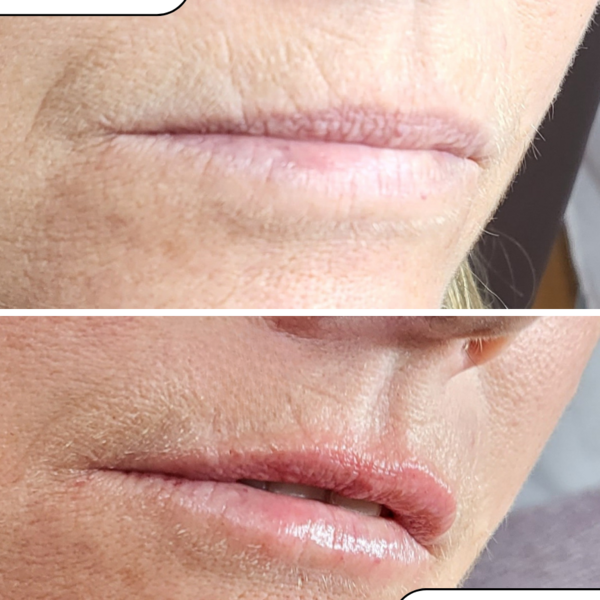 Skinbooster Restylane Vital 