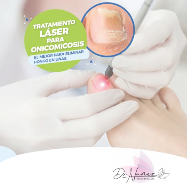 Tratamiento Laser para Onicomicosis 