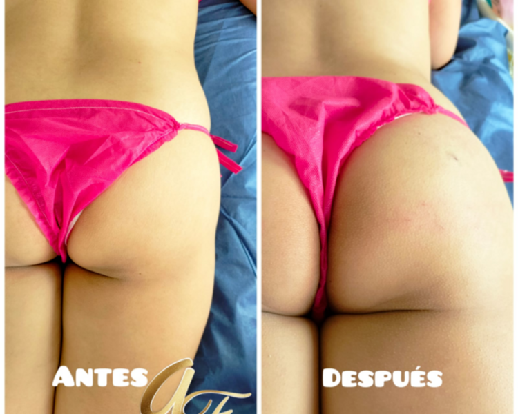 AUMENTO Y MOLDEO DE GLÚTEOS CON PLASMA GEL