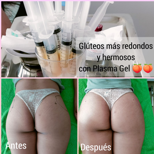 AUMENTO Y MOLDEO DE GLÚTEOS CON PLASMA GEL