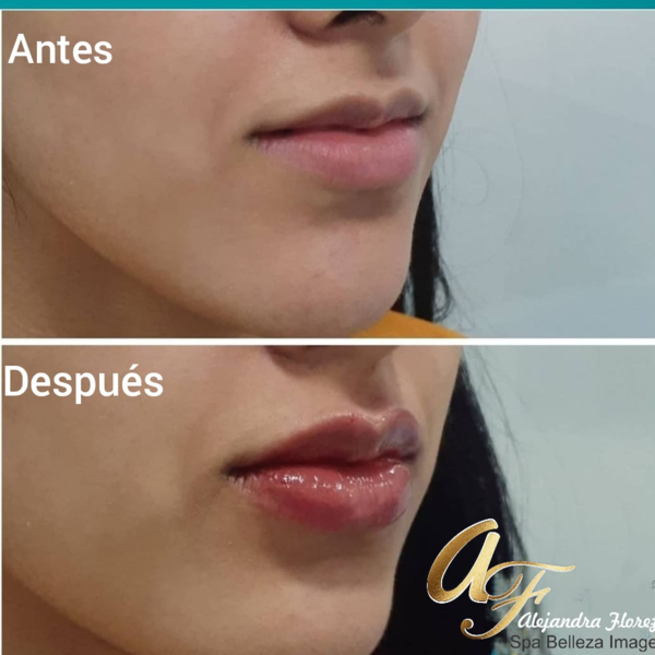 PERFILAMIENTO DE LABIOS 