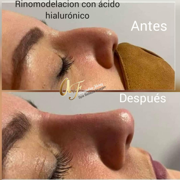 RINOMODELACIÓN CON ACIDO HIALURÓNICO