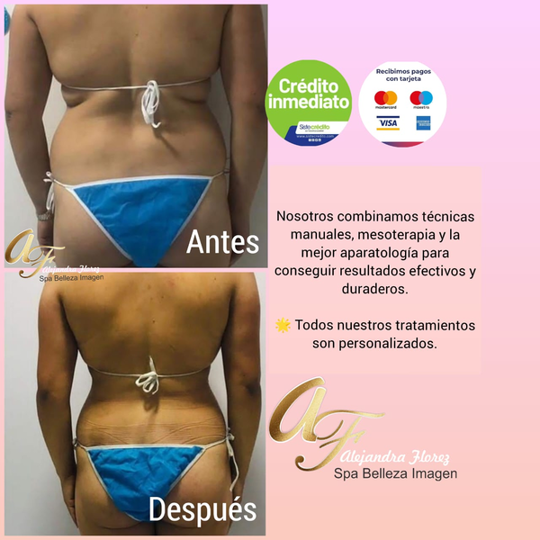 TRATAMIENTO DE REDUCCIÓN SIRENA