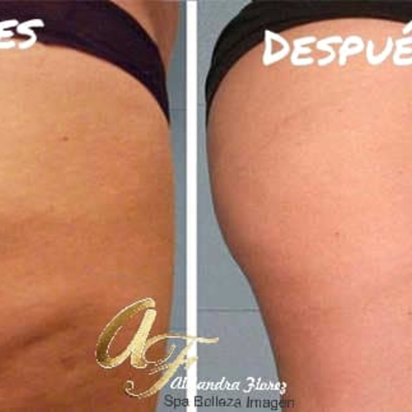 TRATAMIENTO ANTICELULITICO