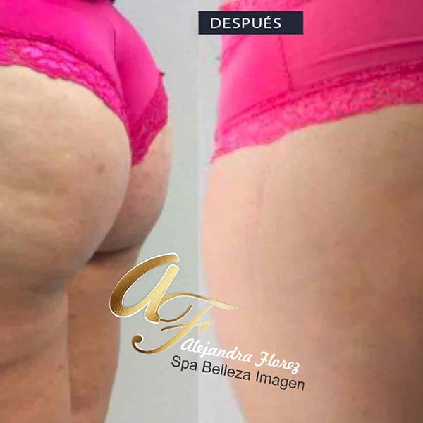 TRATAMIENTO ANTICELULITICO PLUS