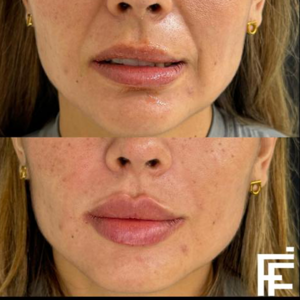 SURCOS NASOGENIANOS F