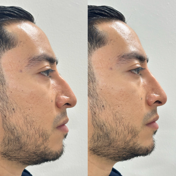 RINOMODELACION F CON CIRUGIA