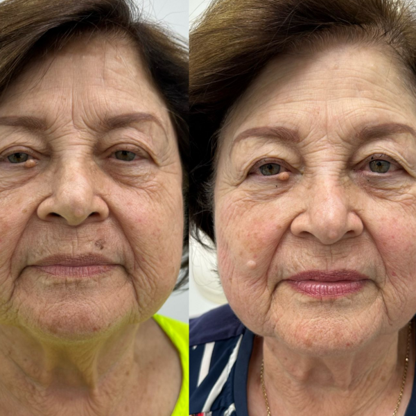 PAQUETE LIFTERA 2 ZONAS