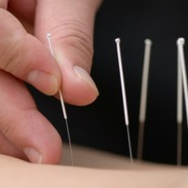 Acupuntura 
