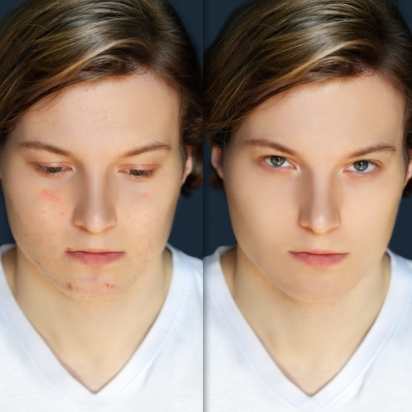 FOTOTERAPIA ANTI-ACNE OPT FACIAL por paquete