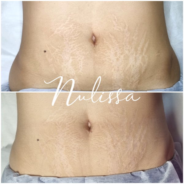 Sesión de Micropuntura