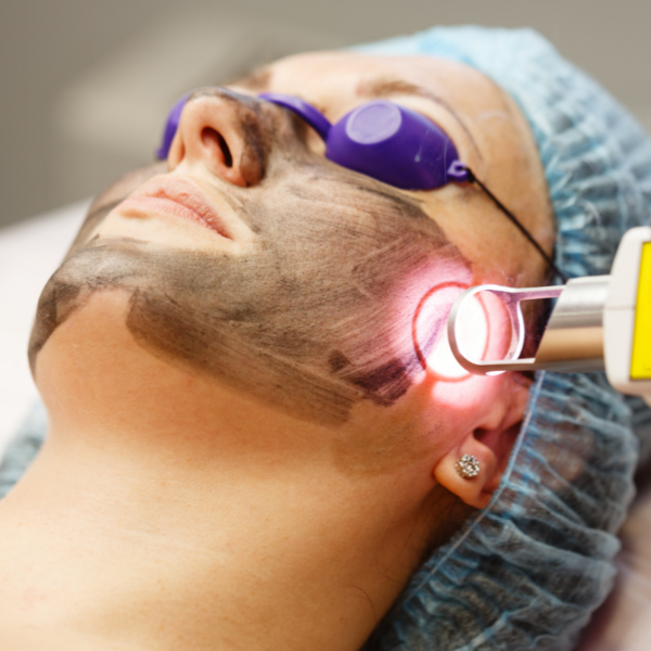 LÁSER HOLLYWOOD  (Incluye un facial con Limpieza)