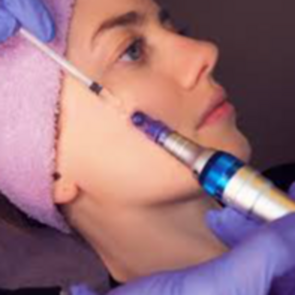Microneedling