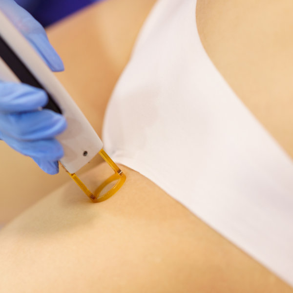 DESPIGMENTANTE CORPORAL DE INGLE por Sesión