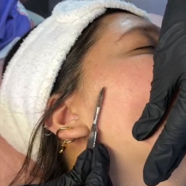 Dermaplaning