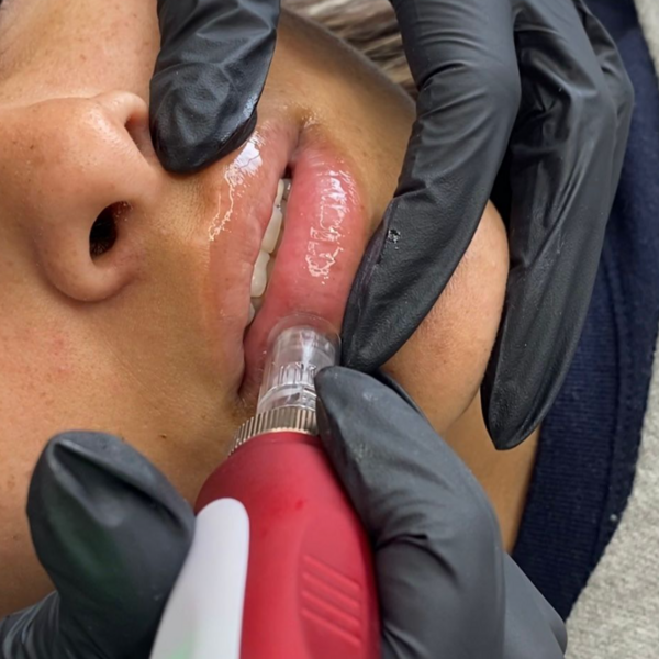 hydra lips