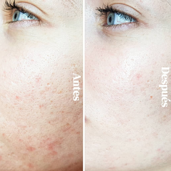 Microneedling con Dermapen (profundo, para cicatrices)