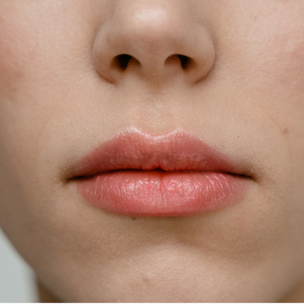 Depilación Láser Nariz 12 Sesiones