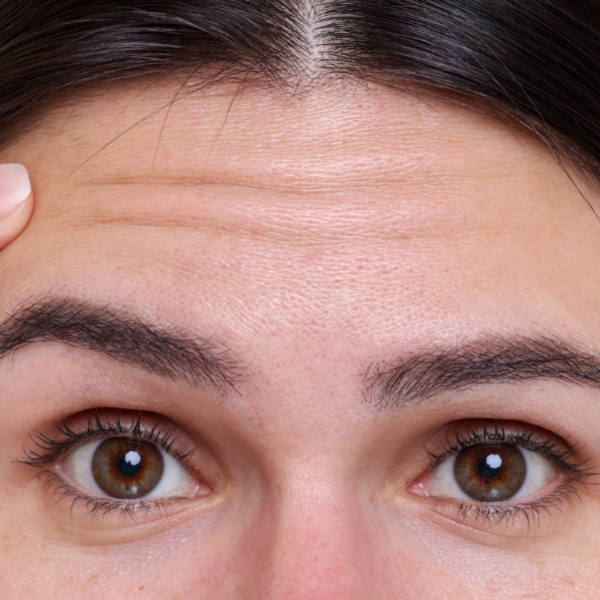 Depilación de Frente por Sesión