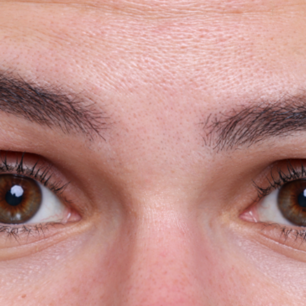 Depilación Láser de Entrecejo por sesion 