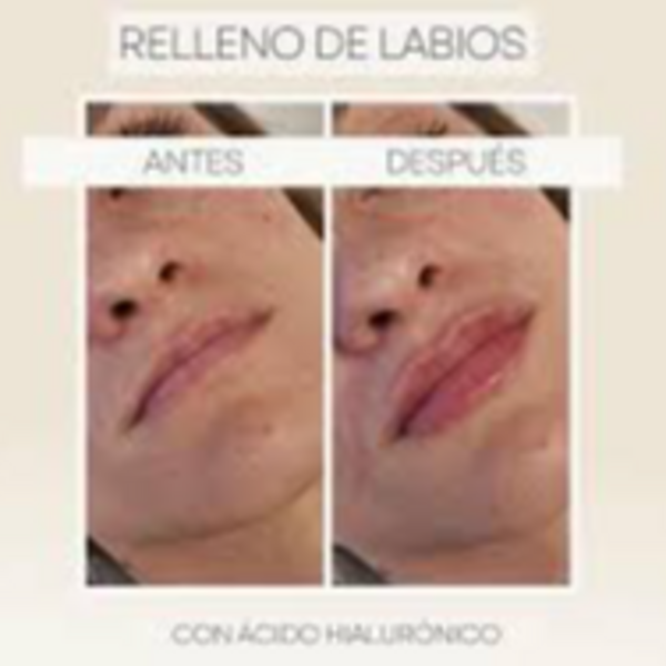 Acido Hialurónico en Labios