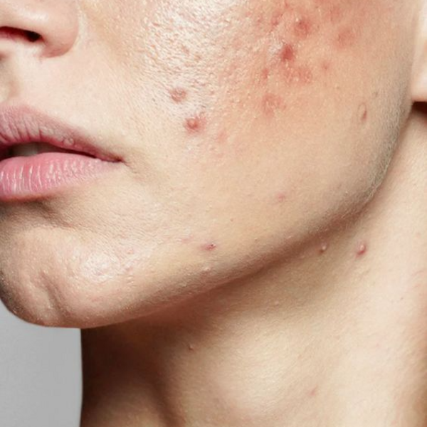 Protocolo Acne 1