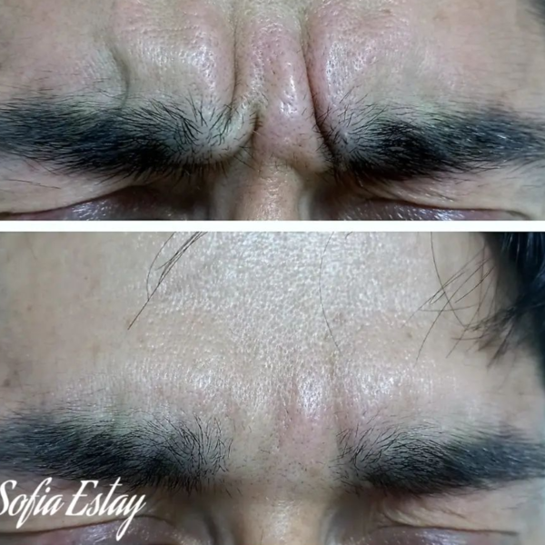 Botox 3 zonas