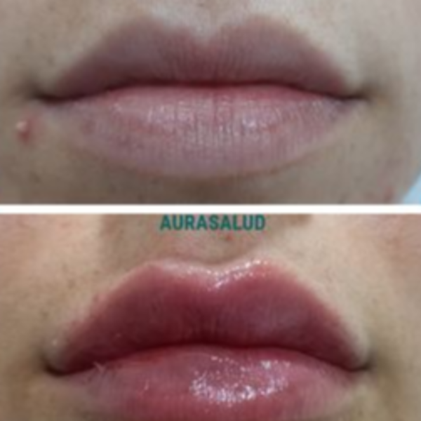Aumento y perfilado de labios