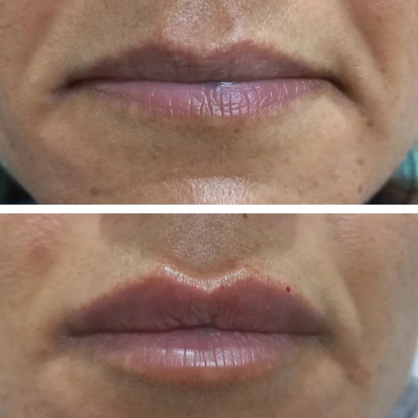 Aumento y perfilado de labios