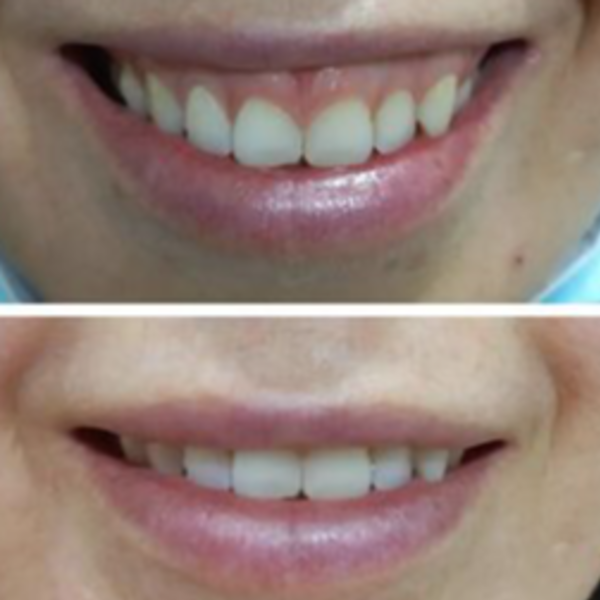 Botox sonrisa gingival