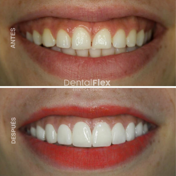 Carillas de Zirconio