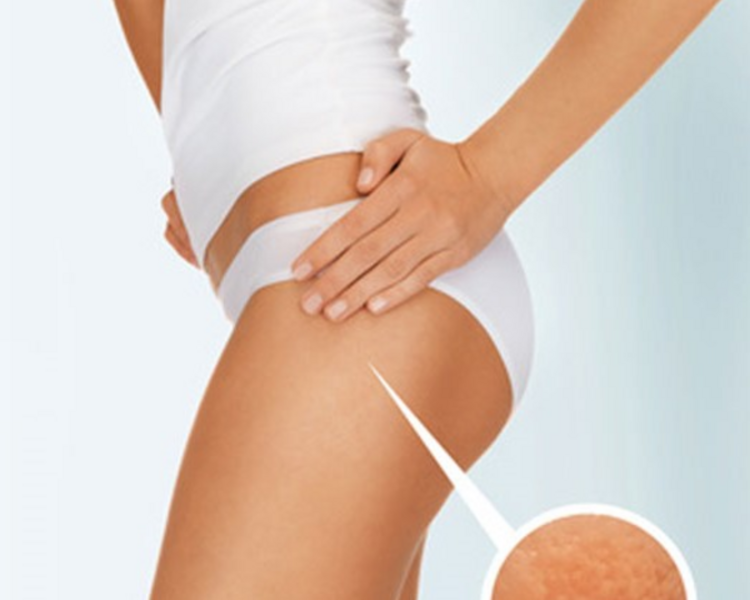 Pack X4 sesiones  (Celulitis  Flacidez y o Estrías)