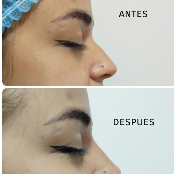 Rinoremodelación