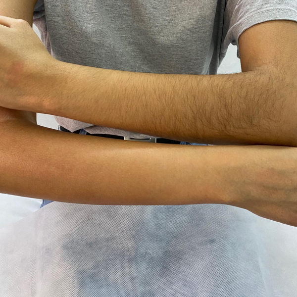 Depilación de brazos