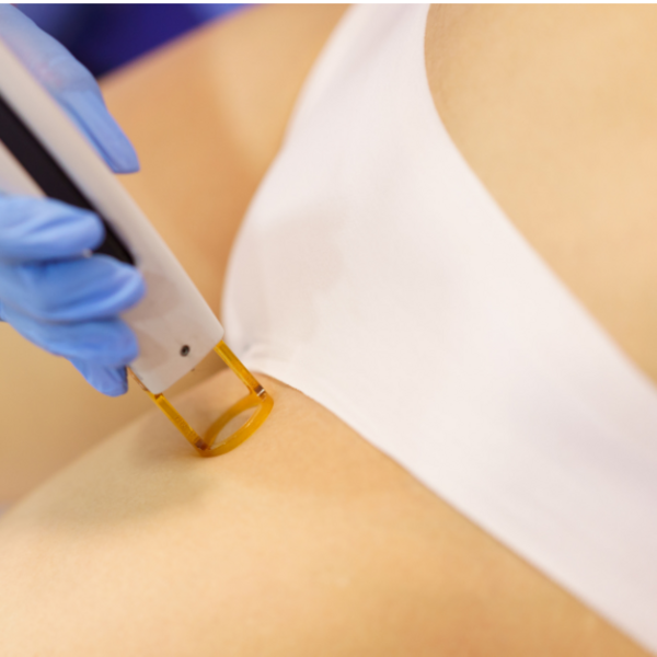 Depilación Láser Ingle 12 Sesiones