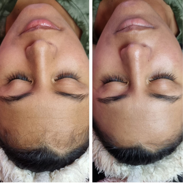 HIGIENE FACIAL PROFUNDA
